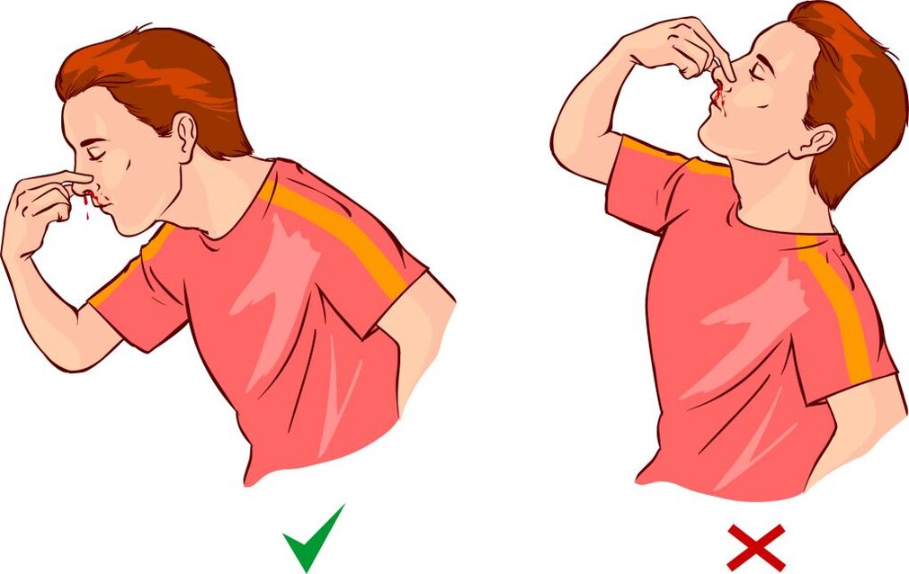 Epistaxis for high blood pressure