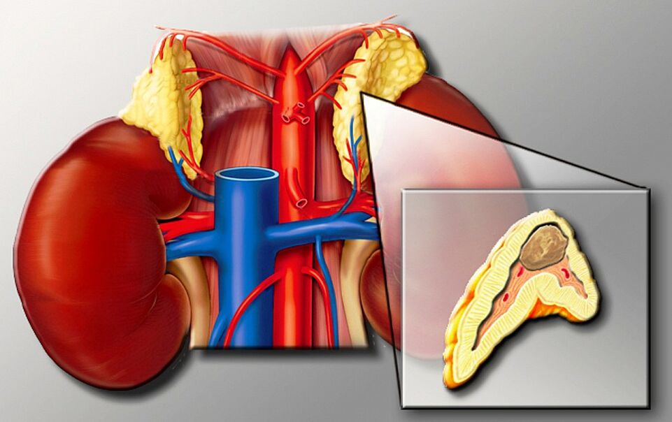 Feochromocytoma against high blood pressure