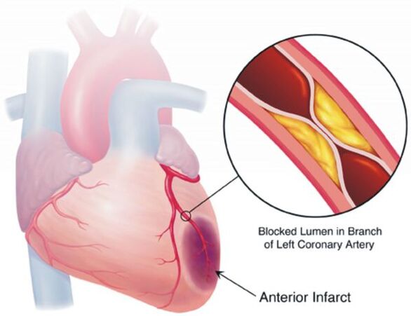 One of the complications of high blood pressure is coronary heart disease.